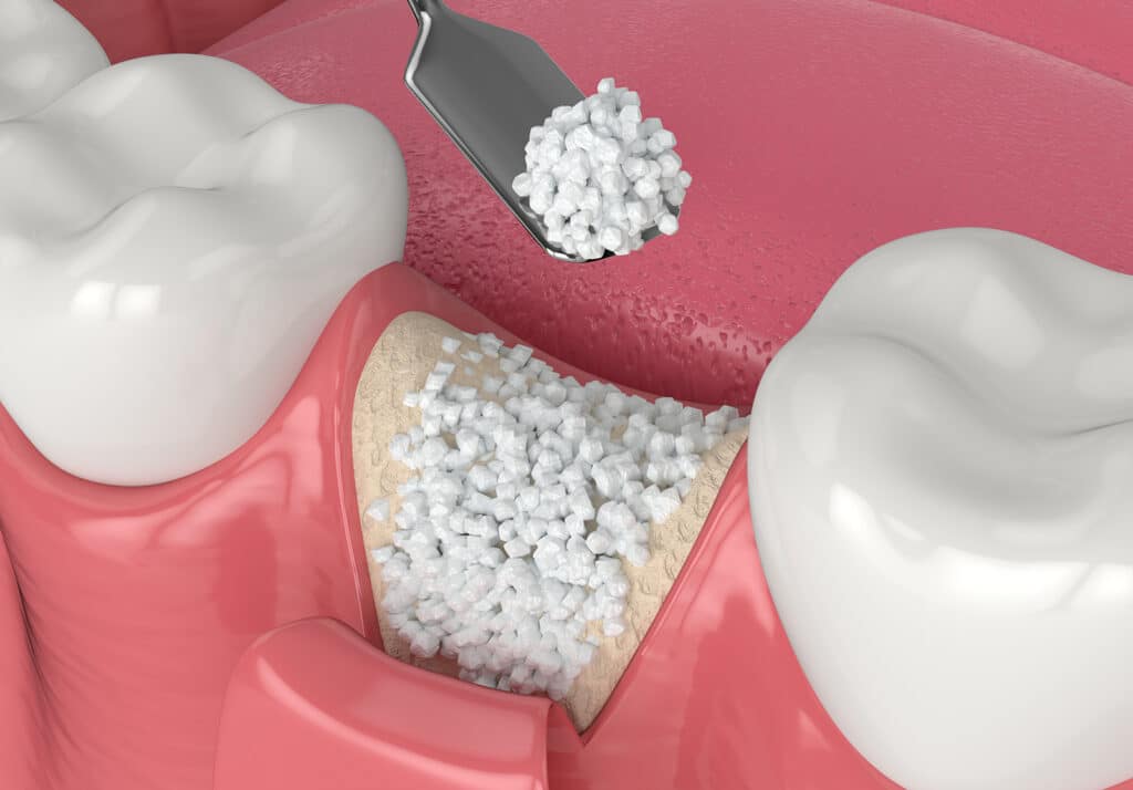 Bone Grafting image