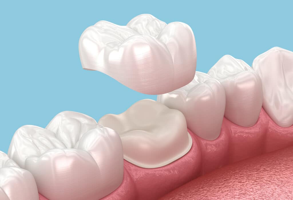 Dental crowns image