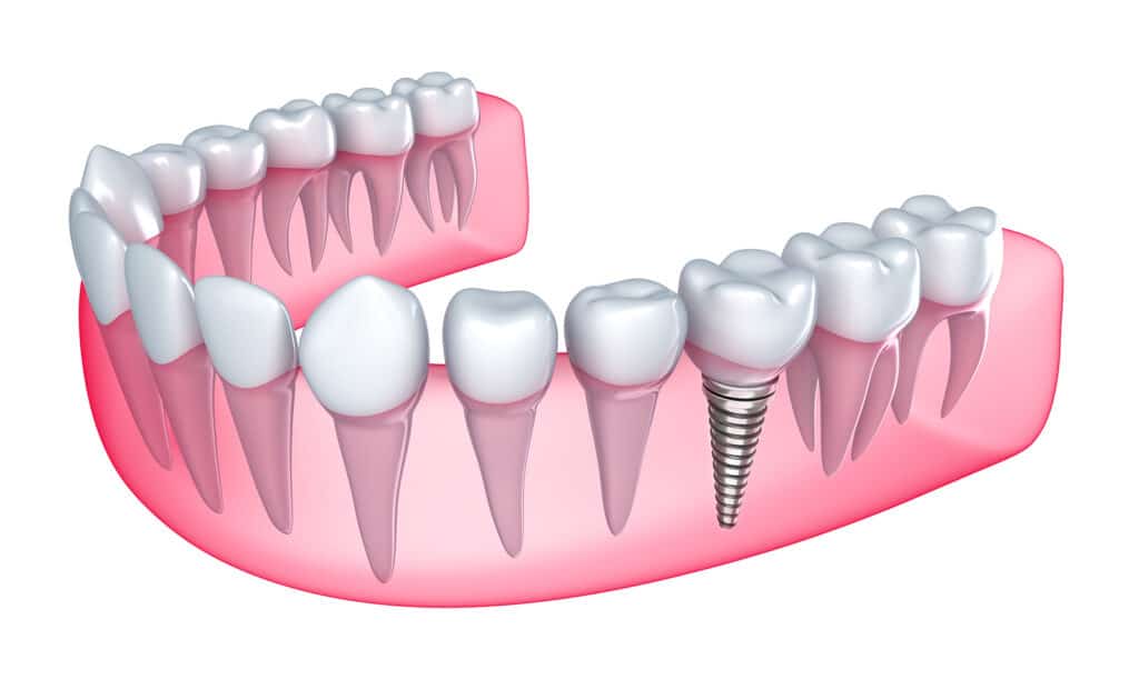 Dental implants image