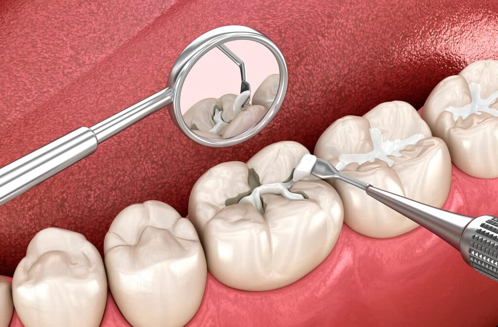 Dental sealants image