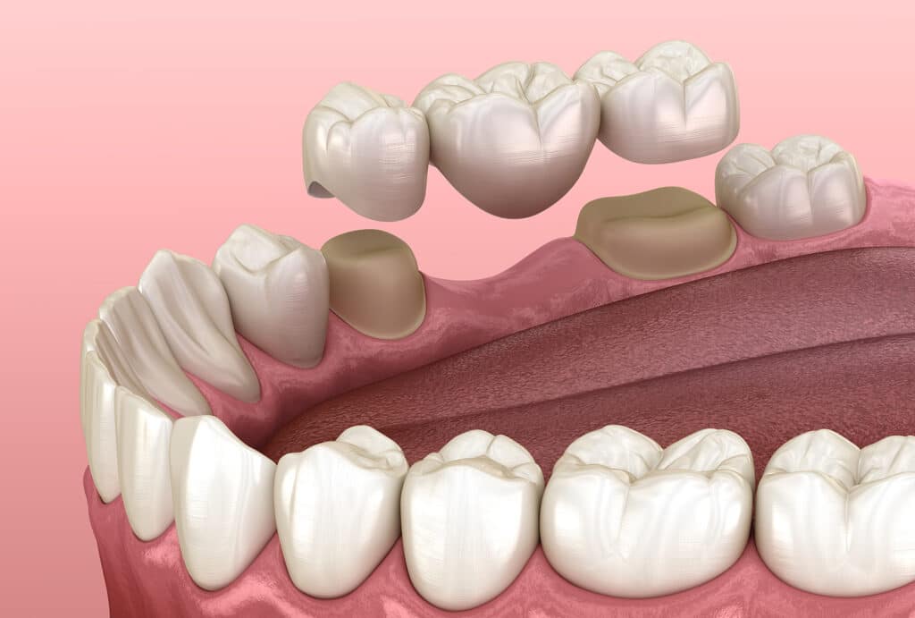 dental bridge image