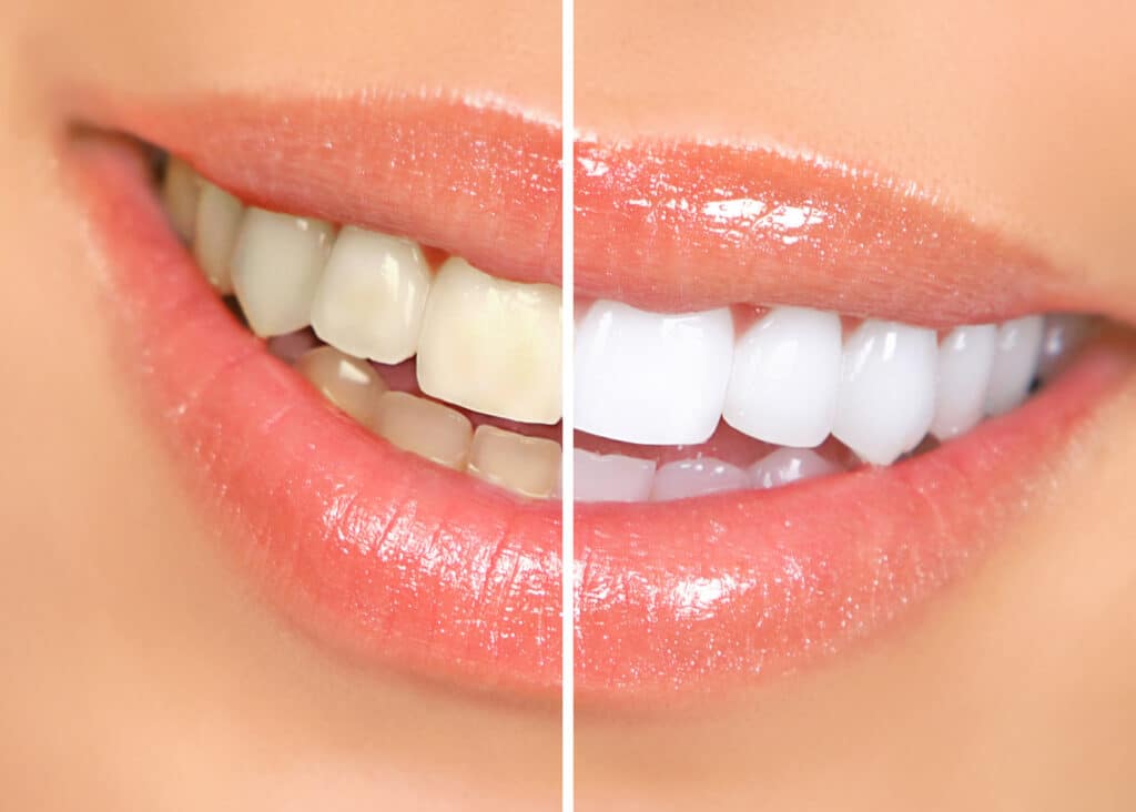 teeth.whitening image